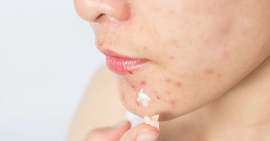 Acne-e1707416058570jpg - Podp Bahia
